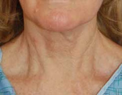 Neck Lift Before & After Gallery - Patient 950924 - Image 1