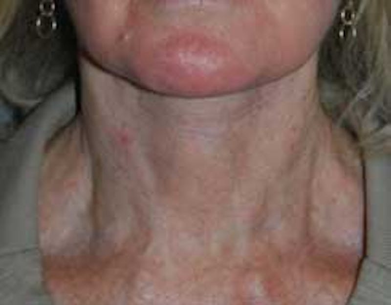 Neck Lift Before & After Gallery - Patient 950924 - Image 2