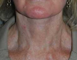 Liposuction Before & After Gallery - Patient 948446 - Image 2