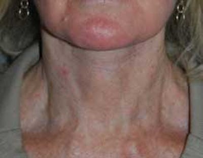 Neck Lift Before & After Gallery - Patient 950924 - Image 2