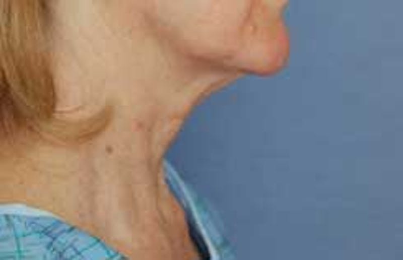Neck Lift Before & After Gallery - Patient 950924 - Image 3