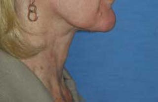 Liposuction Before & After Gallery - Patient 948446 - Image 4
