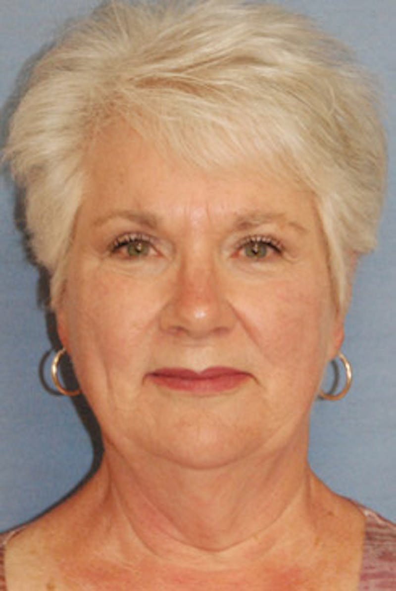 Neck Lift Before & After Gallery - Patient 205389 - Image 1