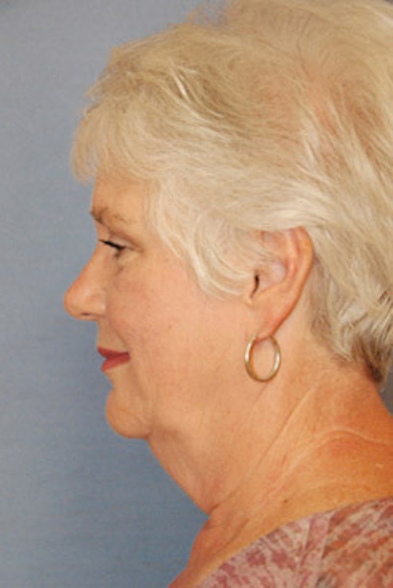 Neck Lift Before & After Gallery - Patient 205389 - Image 3