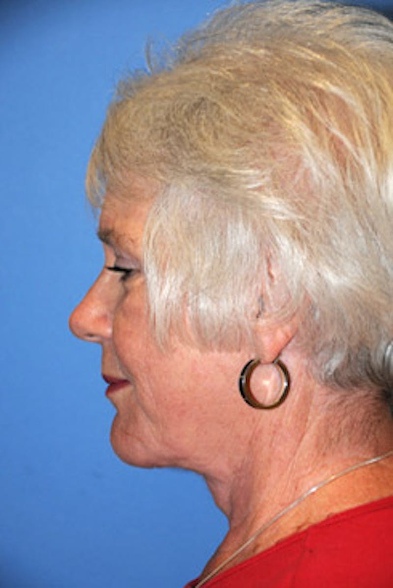 Neck Lift Before & After Gallery - Patient 205389 - Image 4