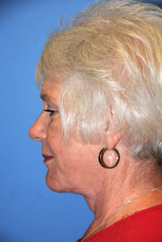 Liposuction Before & After Gallery - Patient 166263 - Image 4
