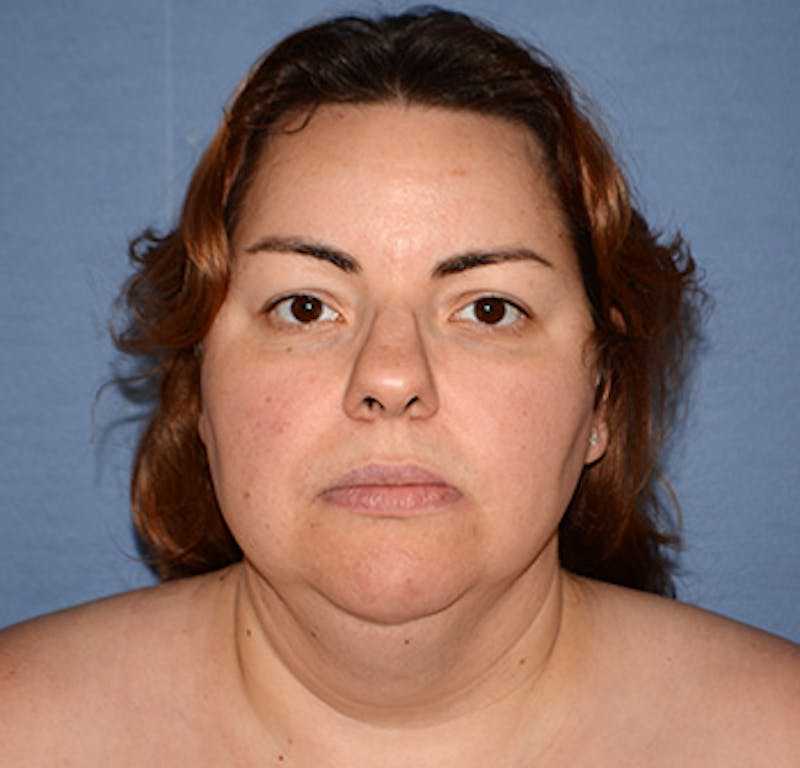 Liposuction Before & After Gallery - Patient 325223 - Image 1