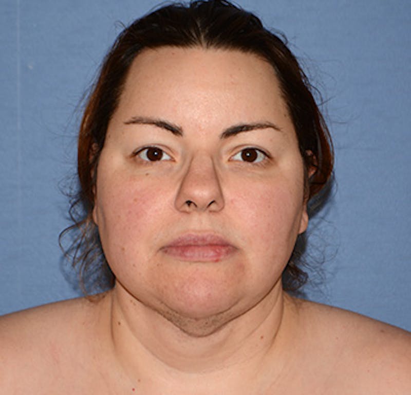 Liposuction Before & After Gallery - Patient 325223 - Image 2