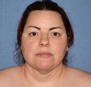 Liposuction Before & After Gallery - Patient 325223 - Image 2