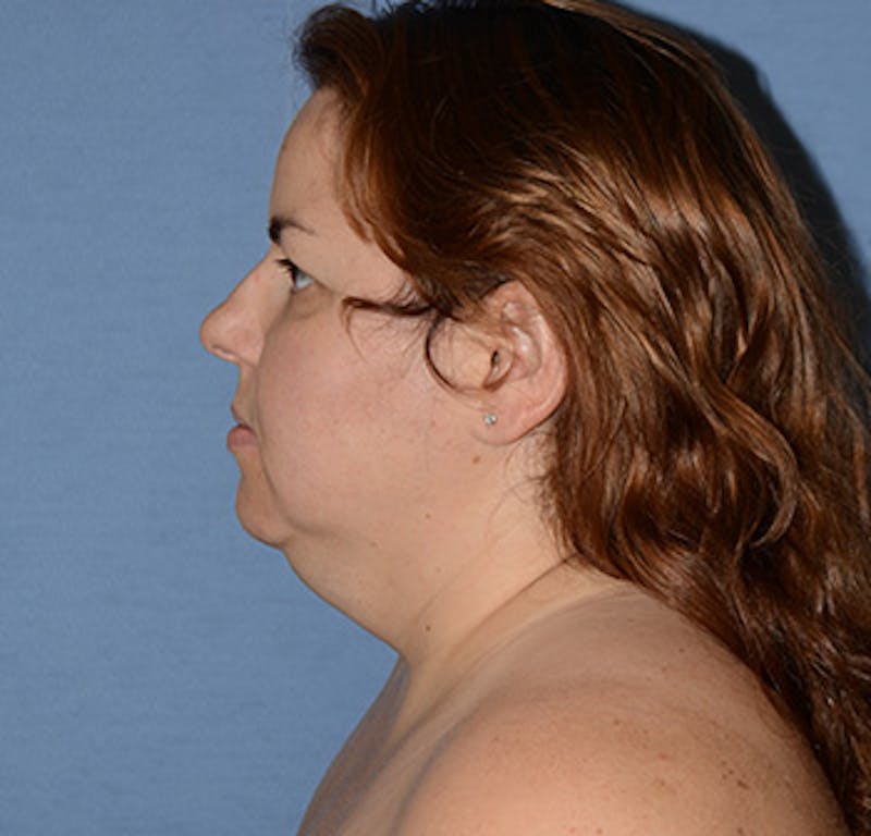 Liposuction Before & After Gallery - Patient 325223 - Image 3