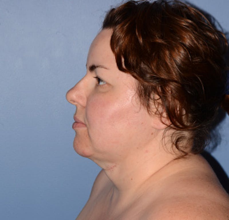 Liposuction Before & After Gallery - Patient 325223 - Image 4