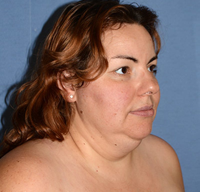 Liposuction Before & After Gallery - Patient 325223 - Image 5