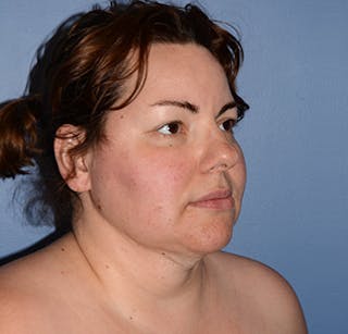 Liposuction Before & After Gallery - Patient 325223 - Image 6