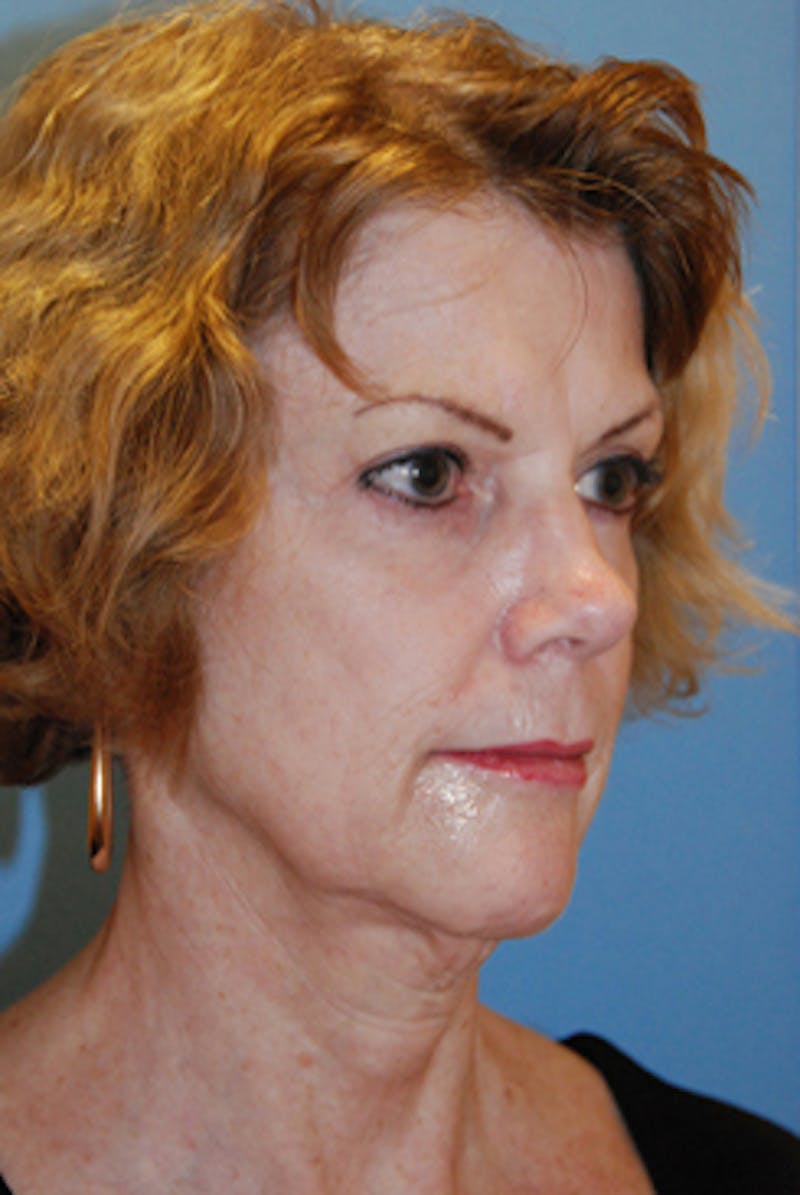 Mid Facelift Galleries Before & After Gallery - Patient 255873 - Image 3