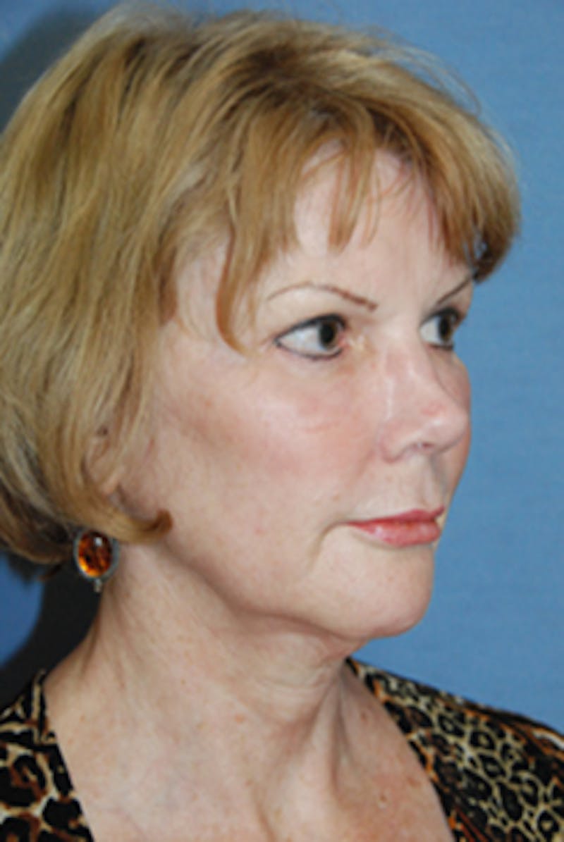 Mid Facelift Galleries Before & After Gallery - Patient 255873 - Image 4