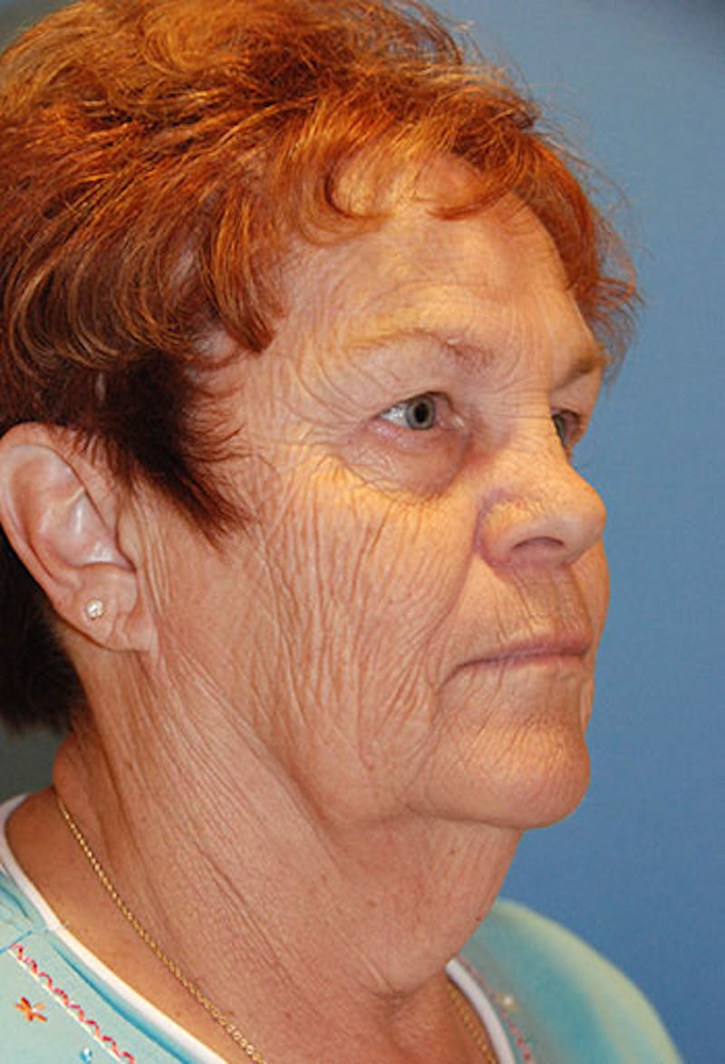 Neck Lift Before & After Gallery - Patient 132575 - Image 1