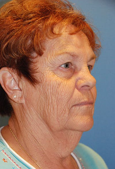Neck Lift Before & After Gallery - Patient 132575 - Image 1