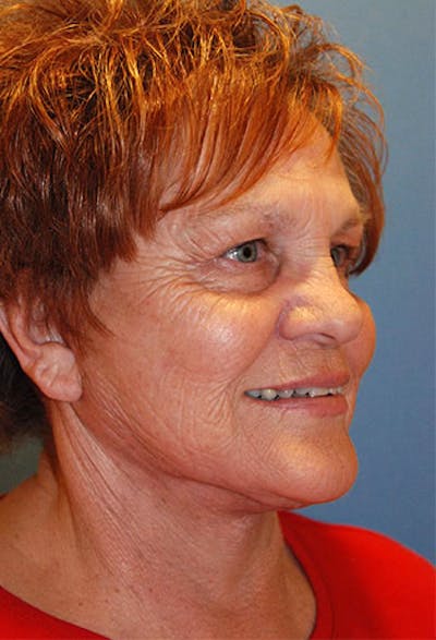 Neck Lift Before & After Gallery - Patient 132575 - Image 2