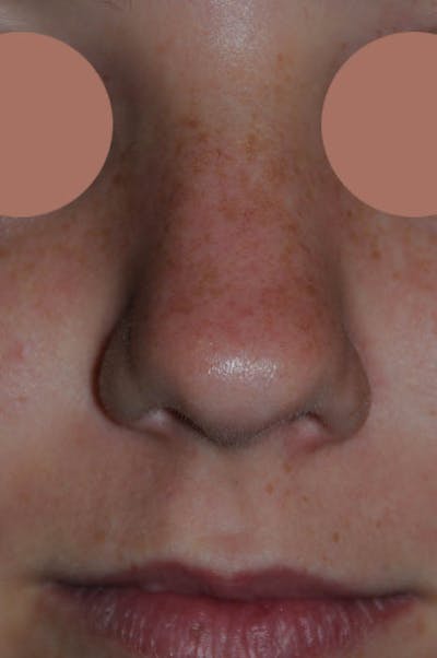 Rhinoplasty Before & After Gallery - Patient 170270 - Image 1