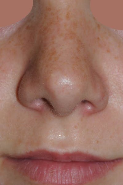 Rhinoplasty Before & After Gallery - Patient 170270 - Image 2