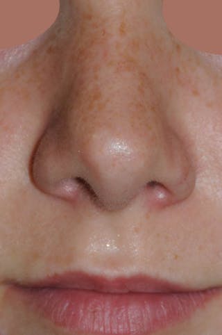 Rhinoplasty Before & After Gallery - Patient 170270 - Image 2