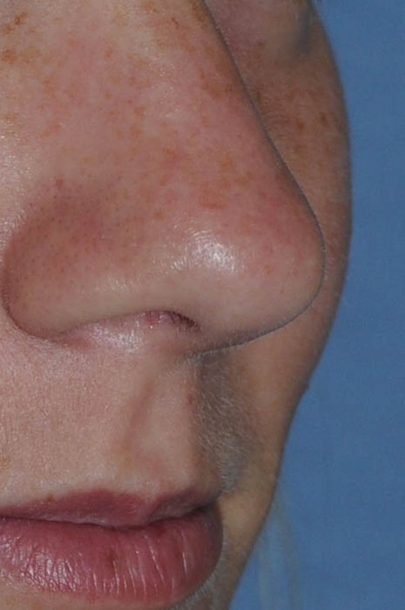 Rhinoplasty Before & After Gallery - Patient 170270 - Image 3