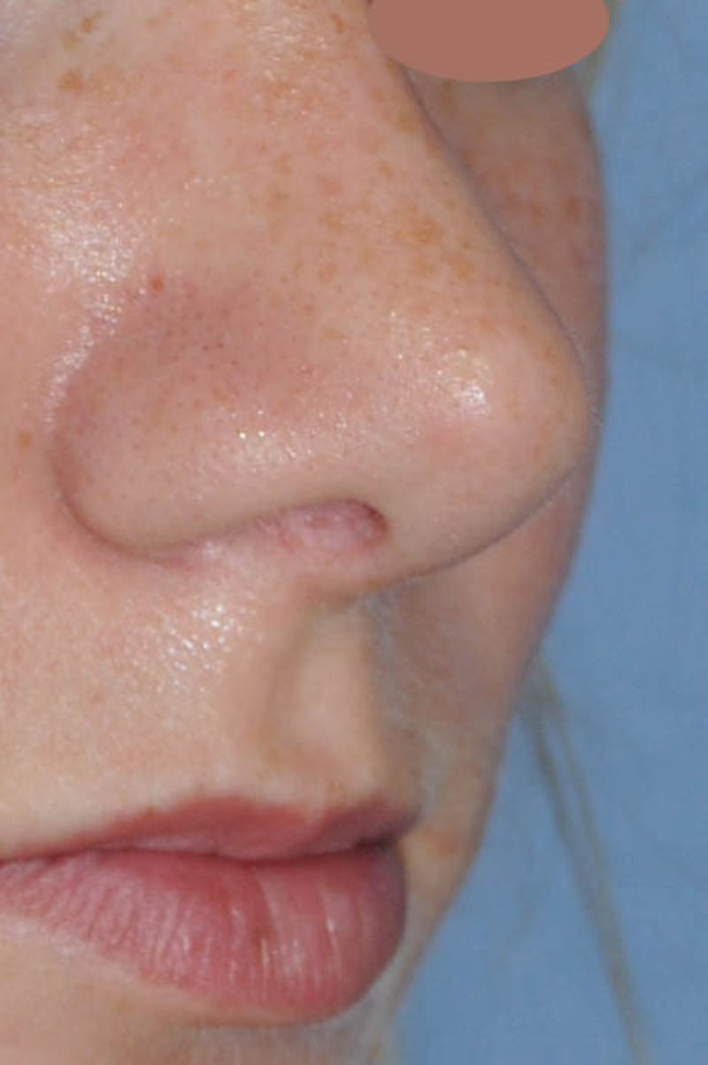 Rhinoplasty Before & After Gallery - Patient 170270 - Image 4