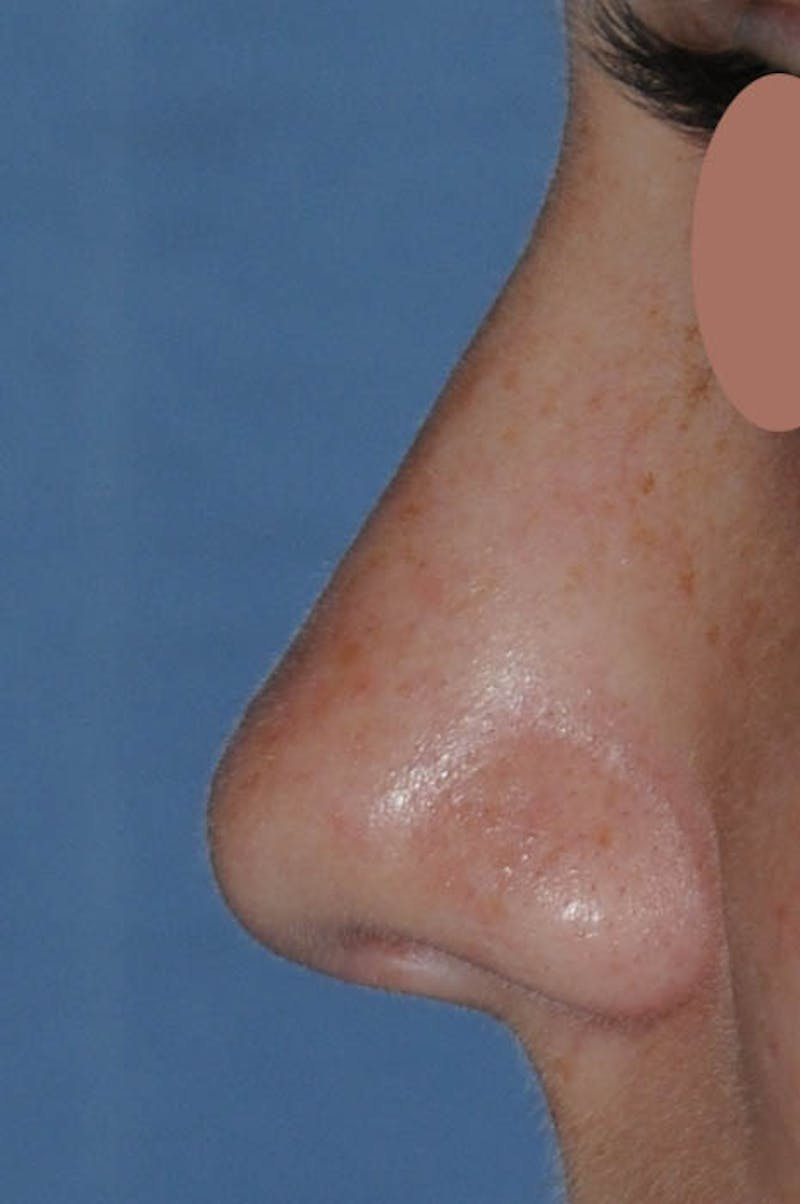 Rhinoplasty Before & After Gallery - Patient 170270 - Image 5