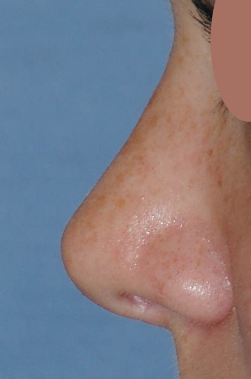 Rhinoplasty Before & After Gallery - Patient 170270 - Image 6