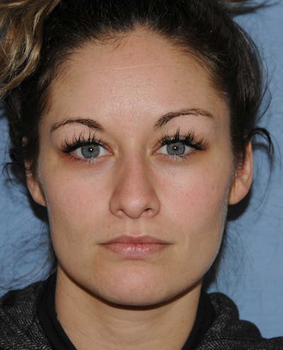 Rhinoplasty Before & After Gallery - Patient 418360 - Image 1