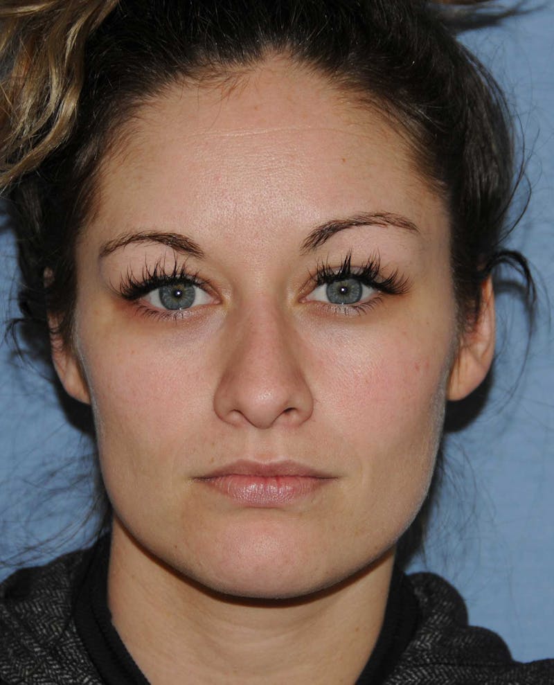 Rhinoplasty Before & After Gallery - Patient 418360 - Image 1