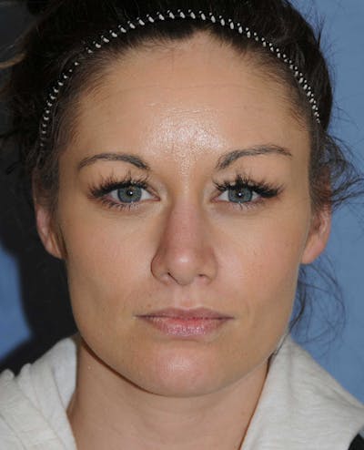 Rhinoplasty Before & After Gallery - Patient 418360 - Image 2