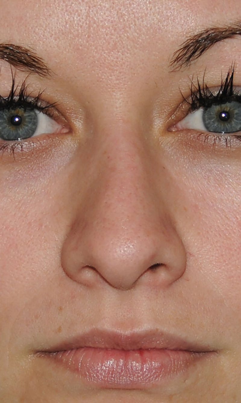 Rhinoplasty Before & After Gallery - Patient 418360 - Image 3