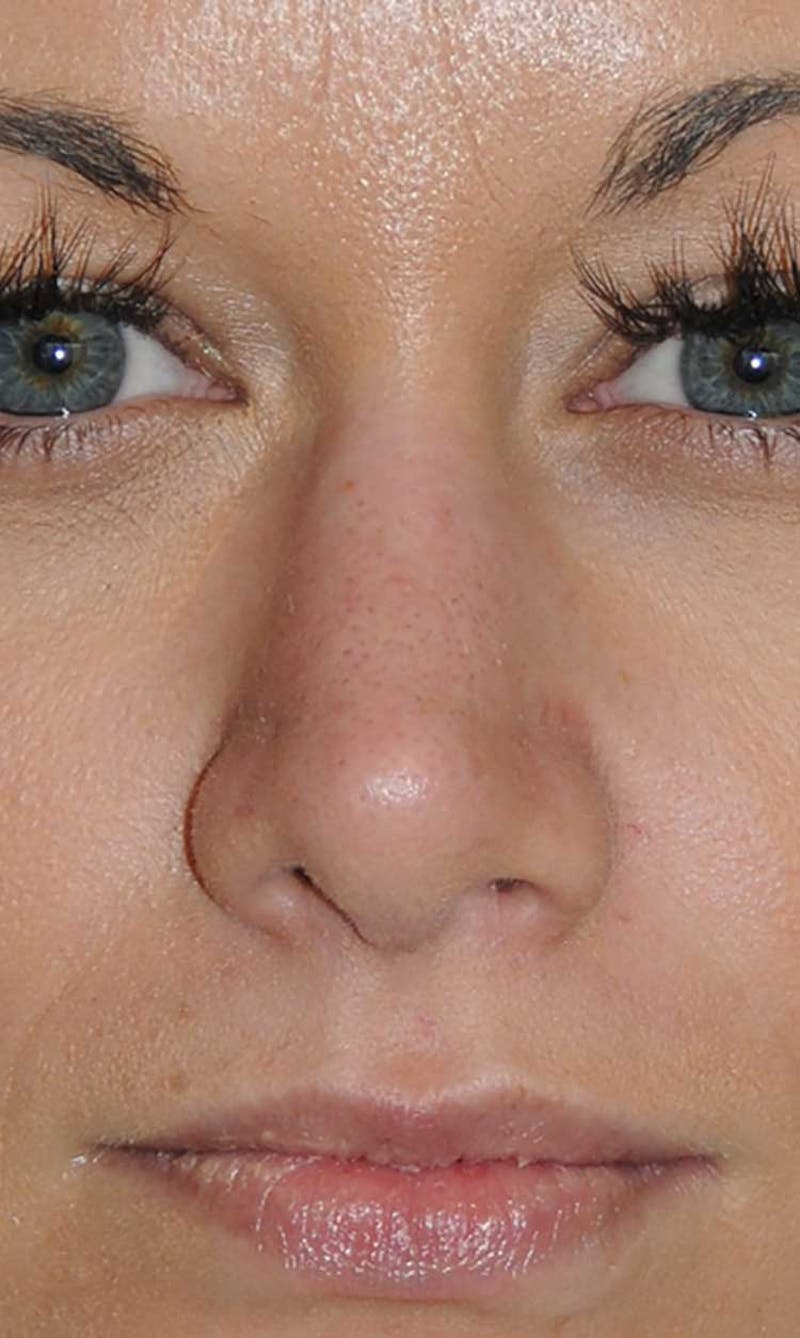 Rhinoplasty Before & After Gallery - Patient 418360 - Image 4