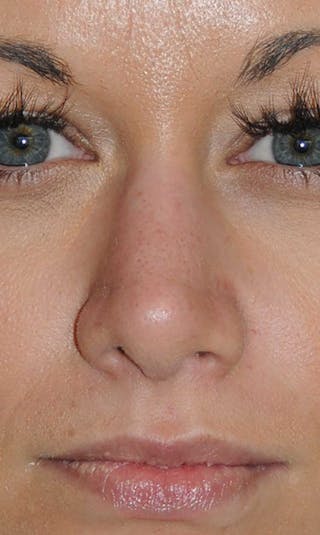 Rhinoplasty Before & After Gallery - Patient 418360 - Image 4