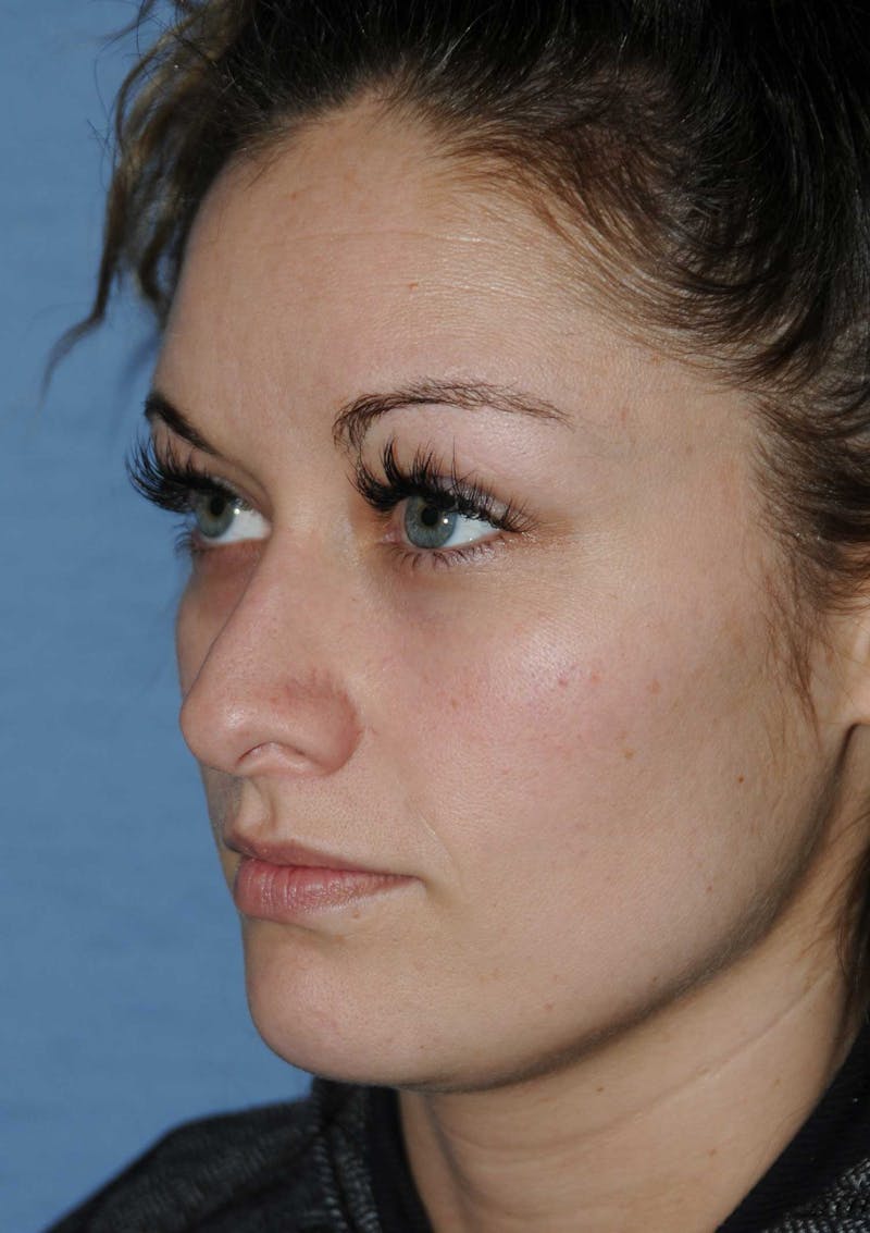Rhinoplasty Before & After Gallery - Patient 418360 - Image 5