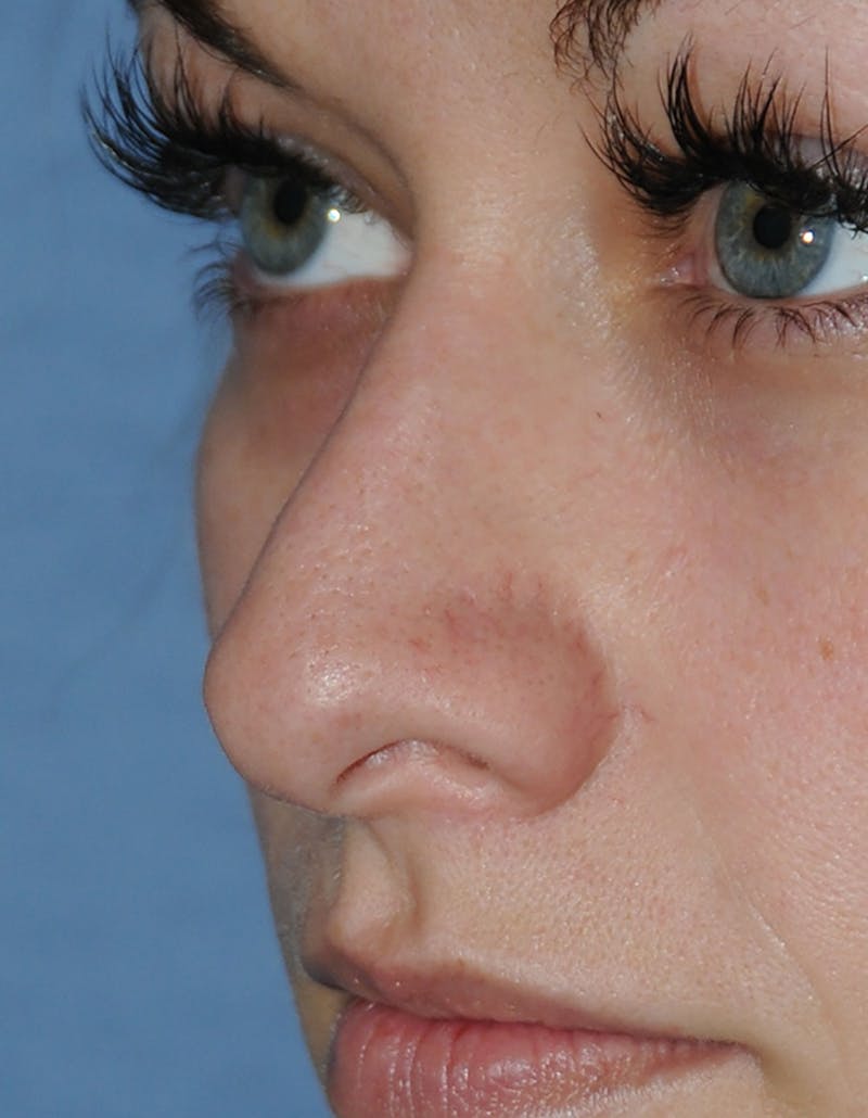 Rhinoplasty Before & After Gallery - Patient 418360 - Image 7