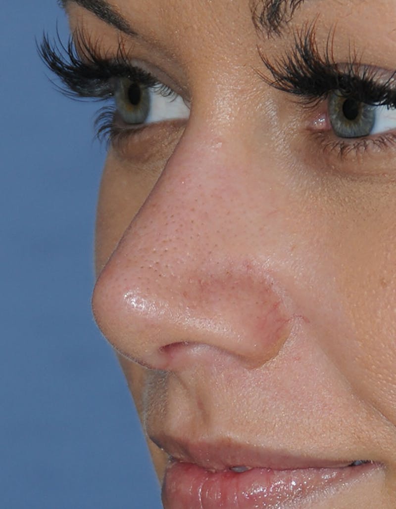 Rhinoplasty Before & After Gallery - Patient 418360 - Image 8