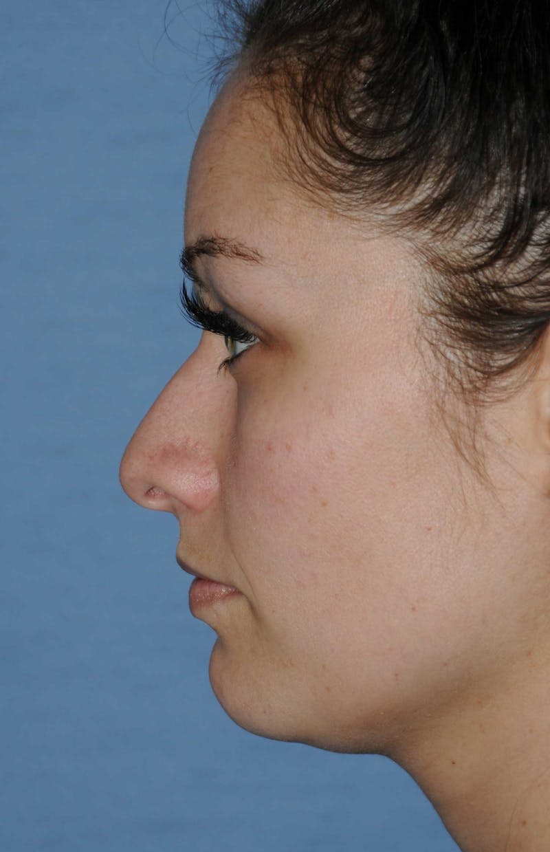 Rhinoplasty Before & After Gallery - Patient 418360 - Image 9