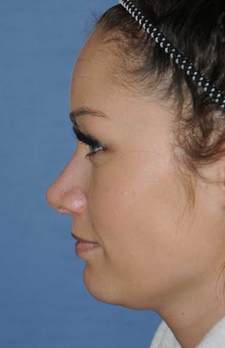 Rhinoplasty Before & After Gallery - Patient 418360 - Image 10