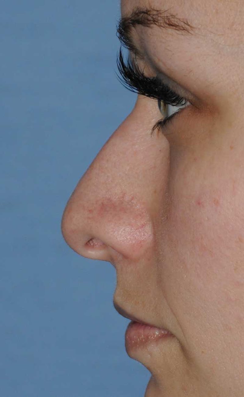 Rhinoplasty Before & After Gallery - Patient 418360 - Image 11