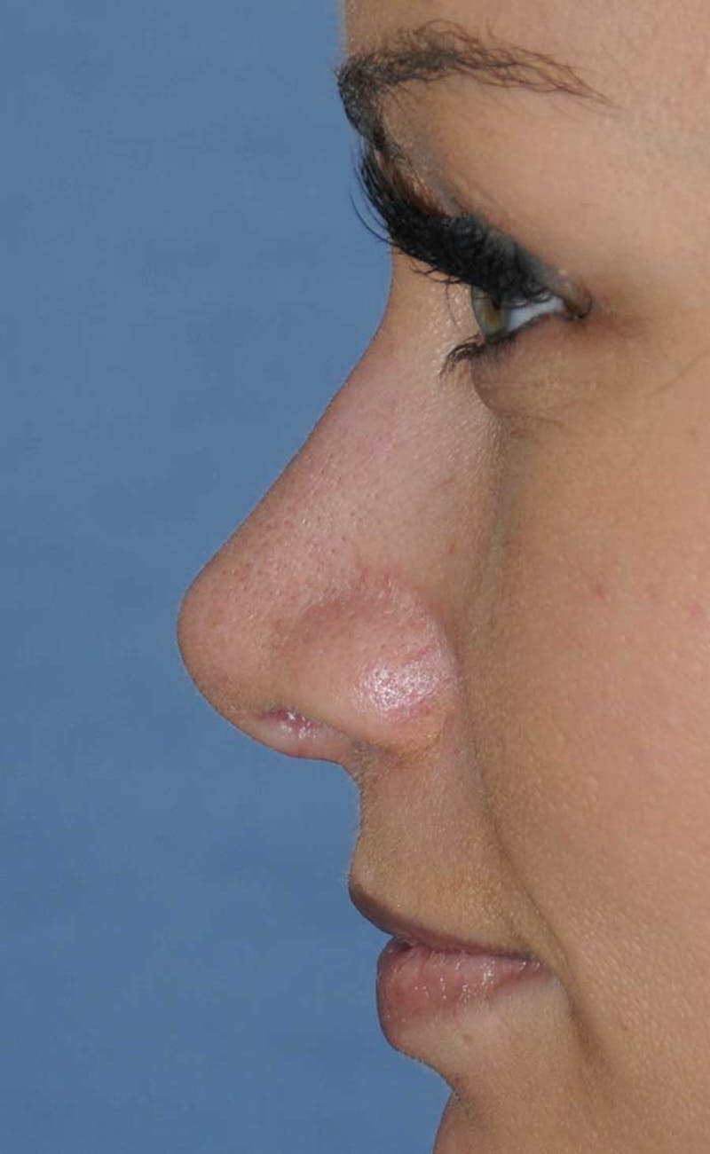 Rhinoplasty Before & After Gallery - Patient 418360 - Image 12