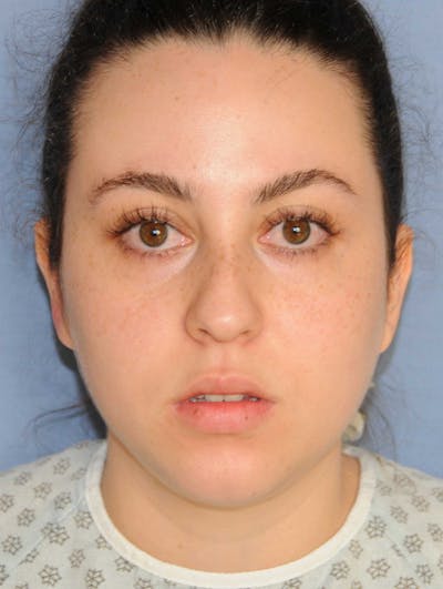 Rhinoplasty Before & After Gallery - Patient 309594 - Image 1