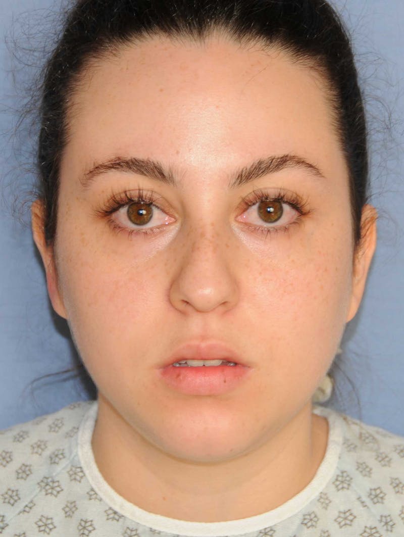 Rhinoplasty Before & After Gallery - Patient 309594 - Image 1