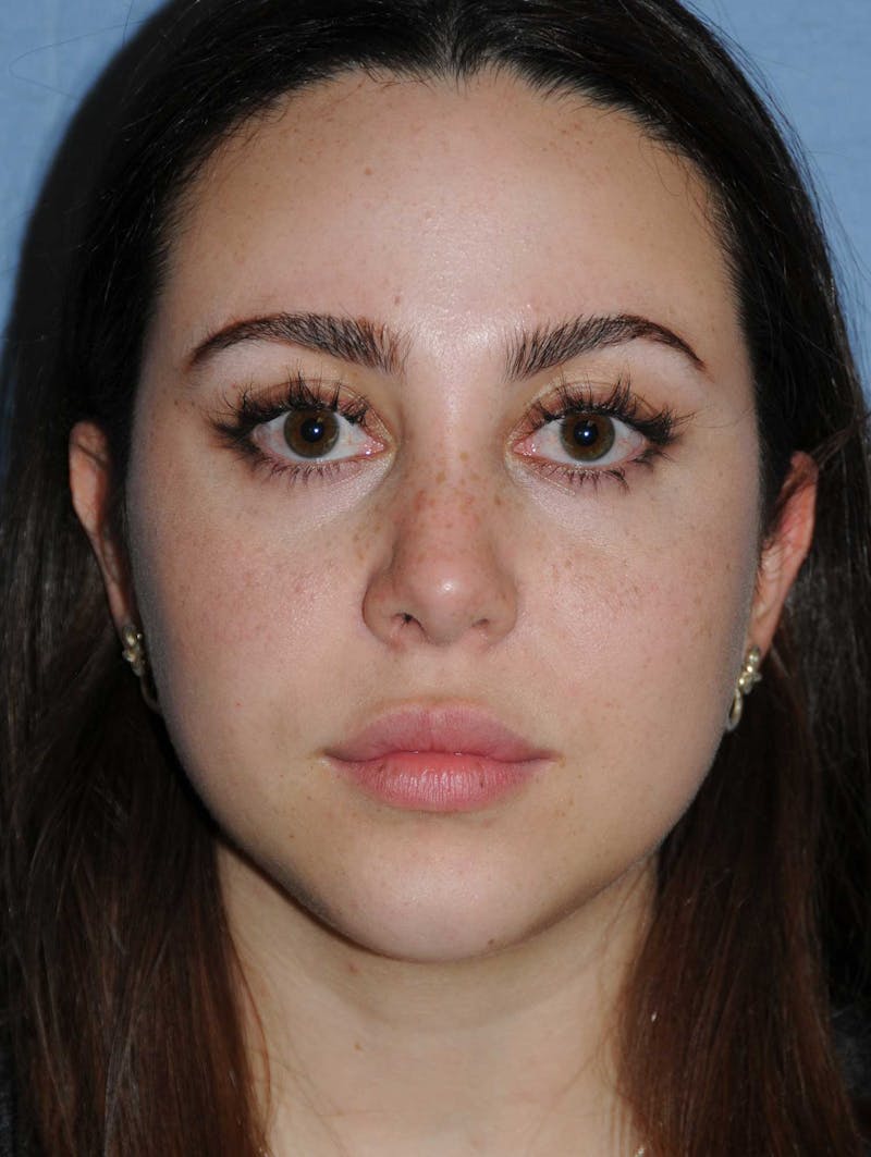 Rhinoplasty Before & After Gallery - Patient 309594 - Image 2