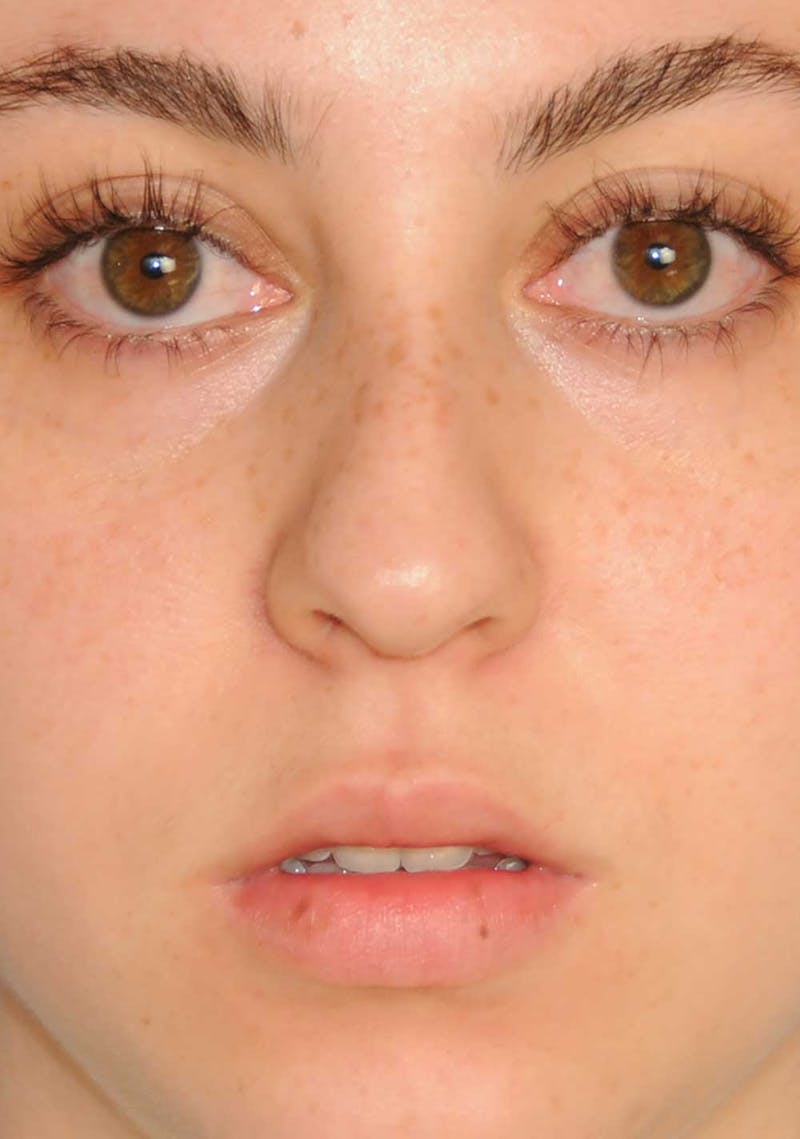 Rhinoplasty Before & After Gallery - Patient 309594 - Image 3