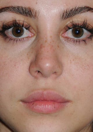 Rhinoplasty Before & After Gallery - Patient 309594 - Image 4