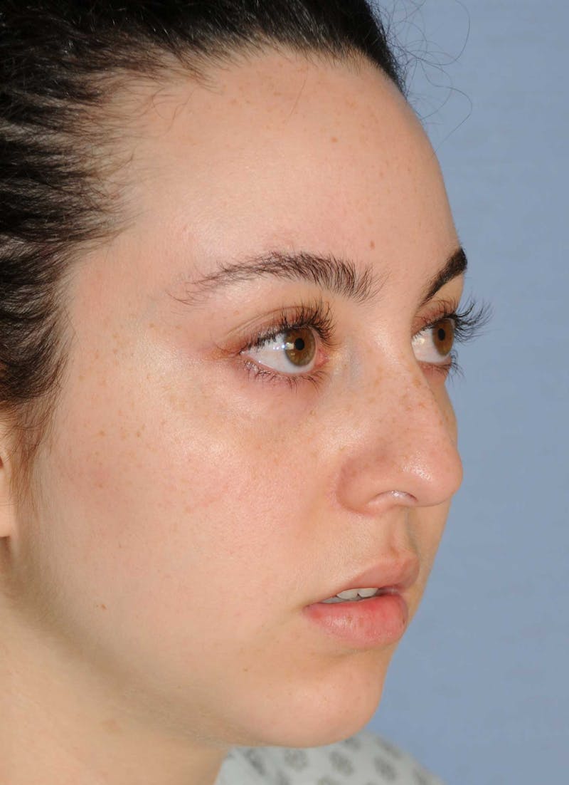 Rhinoplasty Before & After Gallery - Patient 309594 - Image 5