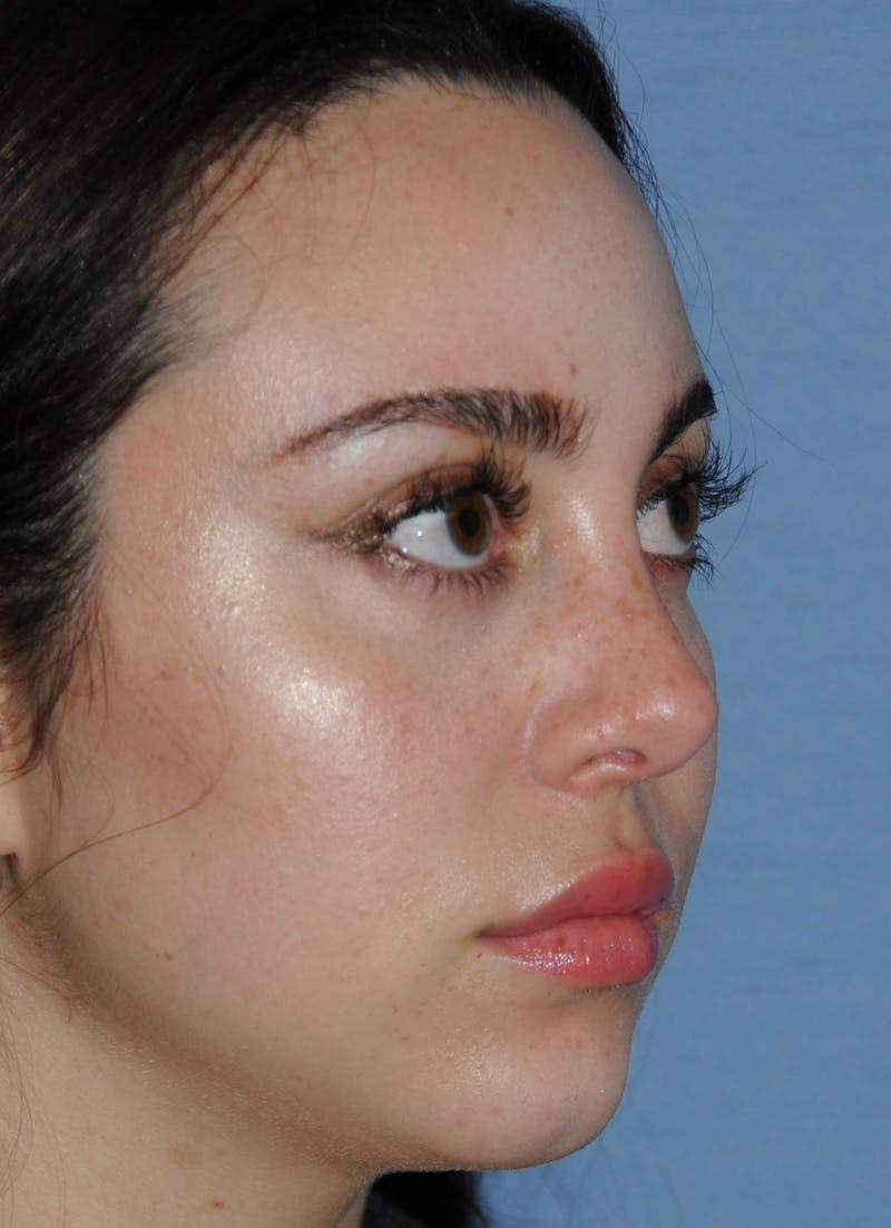Rhinoplasty Before & After Gallery - Patient 309594 - Image 6