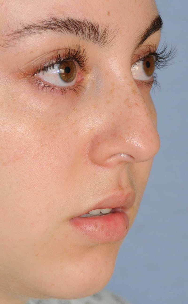 Rhinoplasty Before & After Gallery - Patient 309594 - Image 7